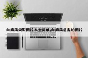 白癜风类型图片大全简单,白癜风患者的图片