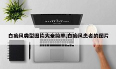 白癜风类型图片大全简单,白癜风患者的图片