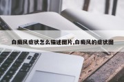 白癜风症状怎么描述图片,白癜风的症状图