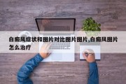 白癜风症状和图片对比图片图片,白癜风图片怎么治疗