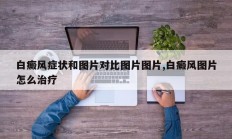 白癜风症状和图片对比图片图片,白癜风图片怎么治疗