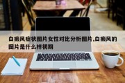 白癜风症状图片女性对比分析图片,白癜风的图片是什么样初期