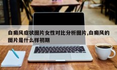 白癜风症状图片女性对比分析图片,白癜风的图片是什么样初期